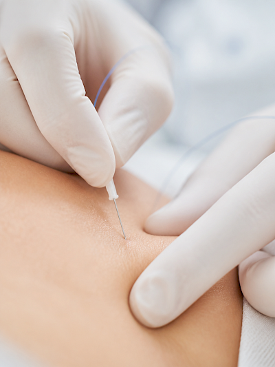 Detail biodermální nitě zaváděné do těla v rukou v bílých rukavicích